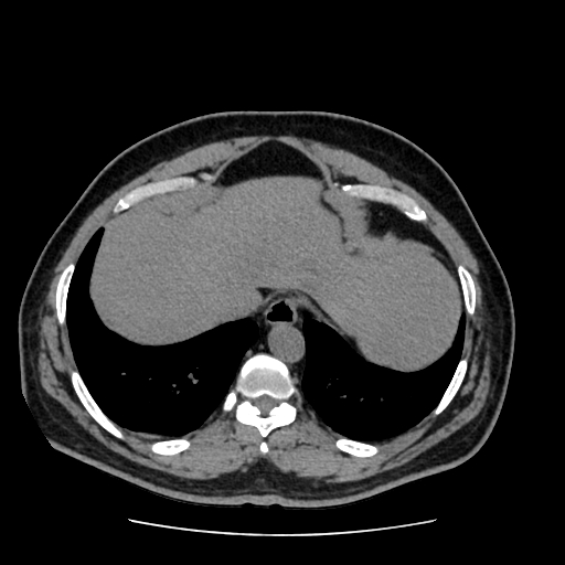 Adrenal myelolipoma and beaver tail liver (Radiopaedia 86201-102193 Axial non-contrast 50).jpg
