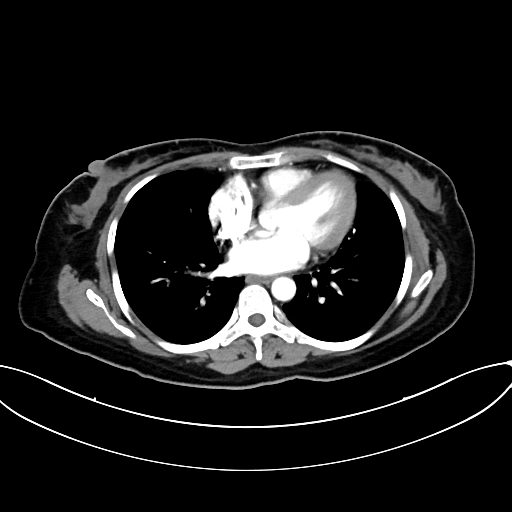 Adrenocortical carcinoma (Radiopaedia 87281-103569 Axial C+ arterial phase 5).jpg