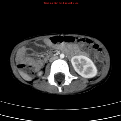 File:Adrenocortical carcinoma (Radiopaedia 9449-10131 Axial C+ portal venous phase 30).jpg