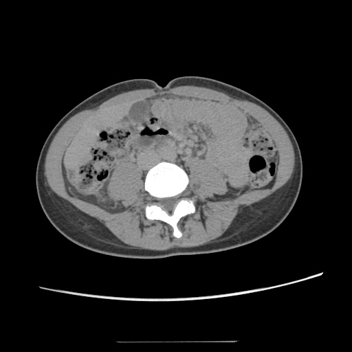 Adult polycystic kidney disease (Radiopaedia 48845-53876 Axial renal excretory phase 55).jpg