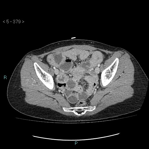 Adult transient intestinal intussusception (Radiopaedia 34853-36310 Axial C+ portal venous phase 97).jpg
