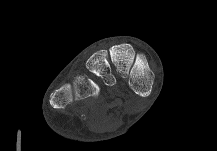 Advanced osteomyelitis due to open metatarsal fracture (Radiopaedia 83891-99095 Axial bone window 23).jpg