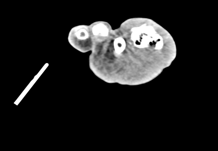 Advanced osteomyelitis due to open metatarsal fracture (Radiopaedia 83891-99095 Axial non-contrast 50).jpg