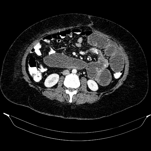 Afferent loop syndrome - secondary to incarcerated trocar site hernia (Radiopaedia 82959-97305 Axial C+ portal venous phase 118).jpg