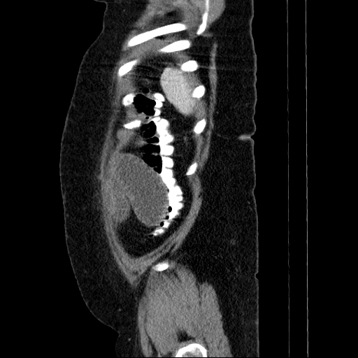 Afferent loop syndrome - secondary to incarcerated trocar site hernia (Radiopaedia 82959-97305 Sagittal C+ portal venous phase 15).jpg
