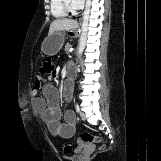 Afferent loop syndrome - secondary to incarcerated trocar site hernia (Radiopaedia 82959-97305 Sagittal C+ portal venous phase 70).jpg
