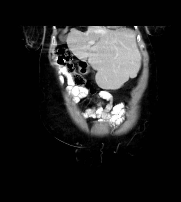 Agenesis of the right hepatic lobe (Radiopaedia 78273-90871 D 64).jpg