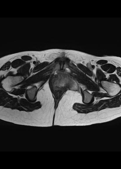 File:Aggressive angiomyxoma of the pelvis and perineum (Radiopaedia 59162-66479 Axial T2 2).jpg