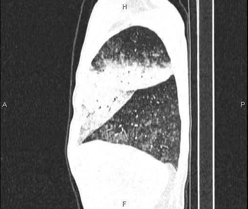File:Air bronchogram in pneumonia (Radiopaedia 85719-101512 Sagittal lung window 20).jpg
