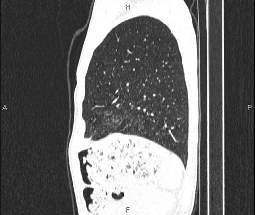 File:Air bronchogram in pneumonia (Radiopaedia 85719-101512 Sagittal lung window 79).jpg