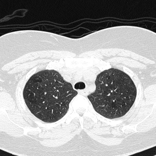 Air trapping in small airway disease (Radiopaedia 61685-69694 Axial lung window 36).jpg