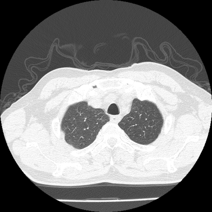Airway foreign body in adult (Radiopaedia 85907-101779 Axial lung window 8).jpg