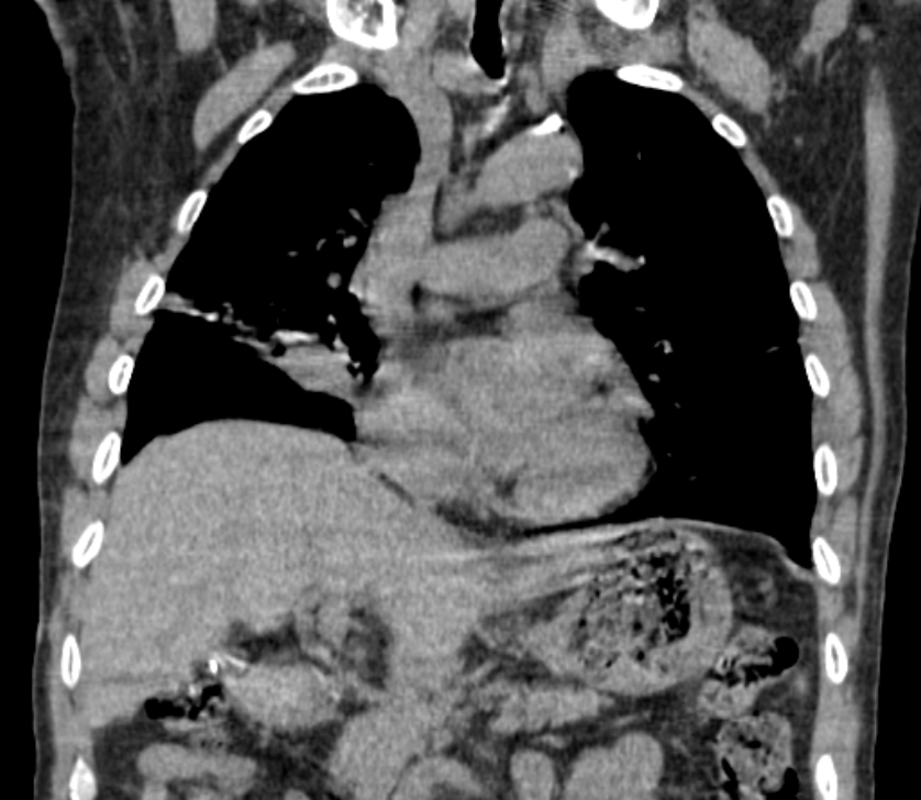 Airway foreign body in adult (Radiopaedia 85907-101779 Coronal liver window 115).jpg