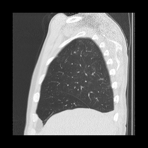 Allergic bronchopulmonary aspergillosis (ABPA) (Radiopaedia 60594-68313 Sagittal lung window 48).jpg