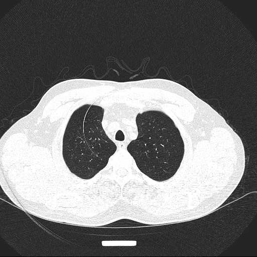 File:Allergic bronchopulmonary aspergillosis (Radiopaedia 21386-21320 Axial lung window 5).jpg