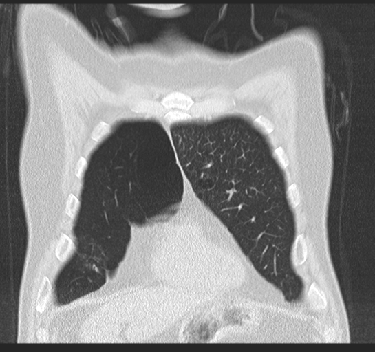 Allergic bronchopulmonary aspergillosis (Radiopaedia 44760-48571 Coronal lung window 14).png