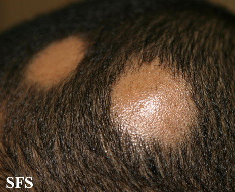 Alopecia Areata (Dermatology Atlas 46).jpg