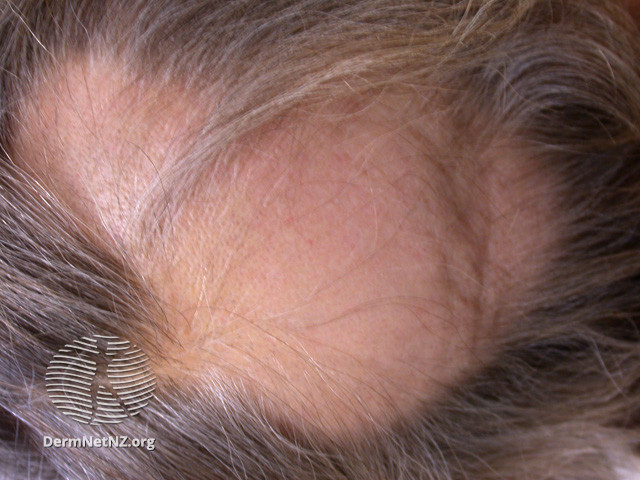 File:Alopecia areata (DermNet NZ hair-nails-sweat-areata1).jpg