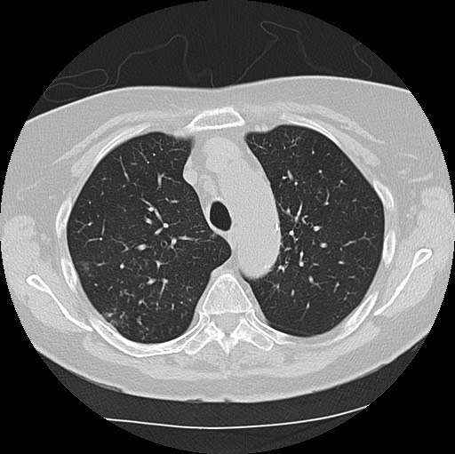 Alpha-1-antitrypsin deficiency (Radiopaedia 72058-82557 Axial lung window 18).jpg