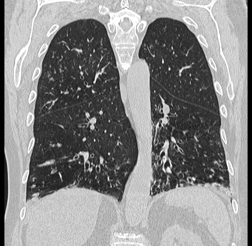 File:Alpha-1-antitrypsin deficiency (Radiopaedia 72058-82557 Coronal lung window 62).jpg