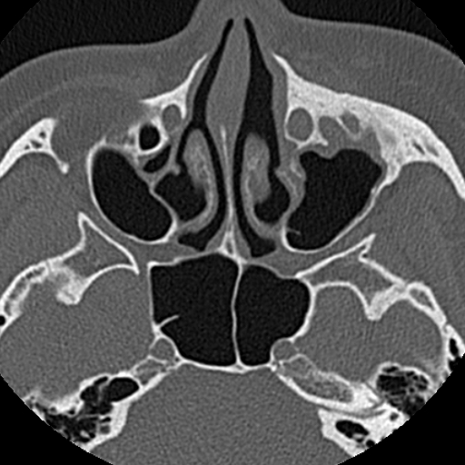 File:Ameloblastic fibro-odontoma (Radiopaedia 18843-18780 C 7).jpg