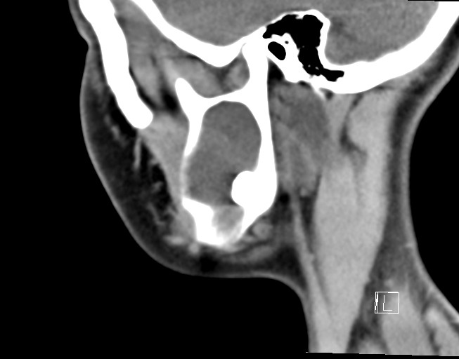 File:Ameloblastoma (Radiopaedia 26645-26793 Sagittal C+ delayed 5).jpg