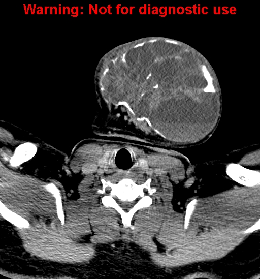 File:Ameloblastoma (Radiopaedia 33126-34164 B 29).jpg