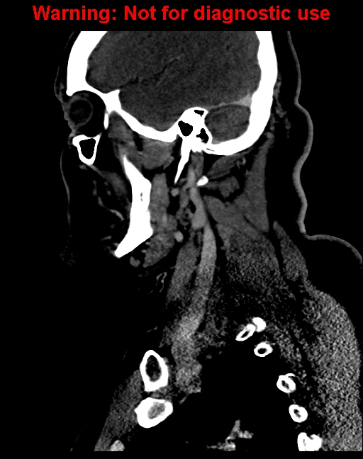 Ameloblastoma (Radiopaedia 33126-34164 F 51).jpg