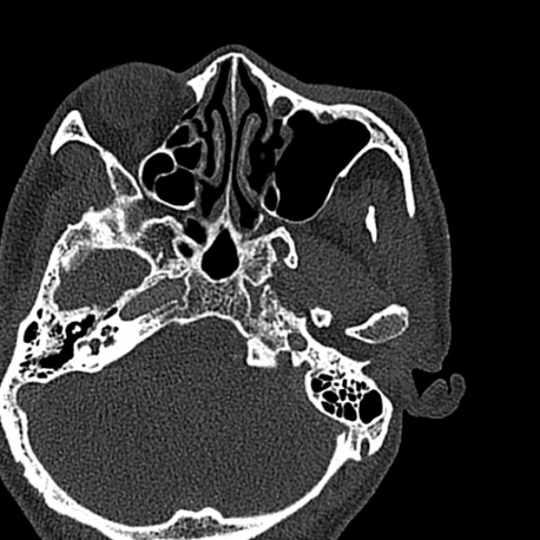 Ameloblastoma (Radiopaedia 51921-57766 Axial bone window 150).jpg