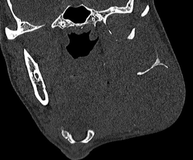 Ameloblastoma (Radiopaedia 51921-57766 Coronal bone window 146).jpg