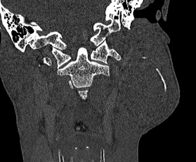 Ameloblastoma (Radiopaedia 51921-57766 Coronal bone window 221).jpg