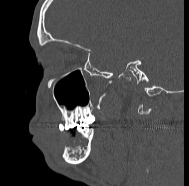 Ameloblastoma (Radiopaedia 77750-89997 Sagittal bone window 46).jpg