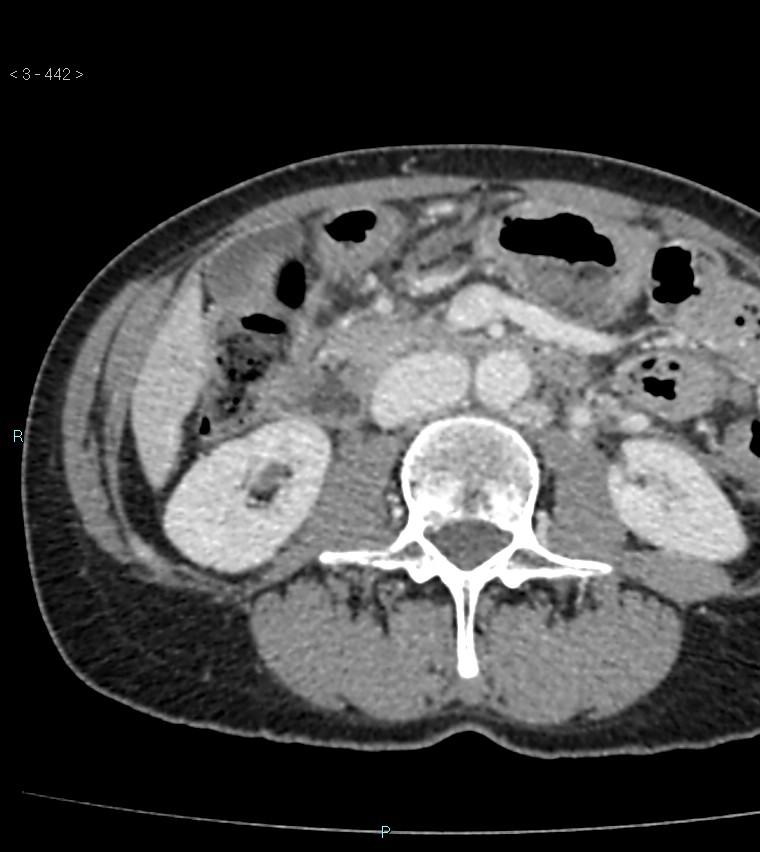 Ampulla of Vater metastasis (Radiopaedia 27820-28065 A 46).jpg
