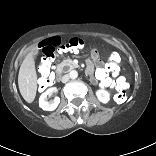 Ampullary adenocarcinoma (Radiopaedia 34013-35237 C 20).png