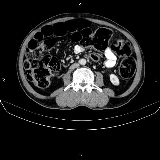 Ampullary adenocarcinoma (Radiopaedia 86093-102032 A 32).jpg
