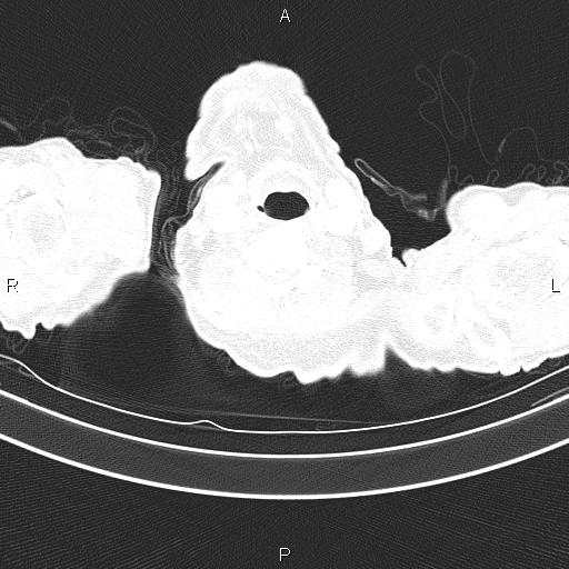 Ampullary adenocarcinoma (Radiopaedia 86093-102033 Axial lung window 4).jpg