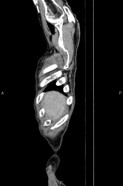 Ampullary adenocarcinoma (Radiopaedia 86093-102033 E 2).jpg