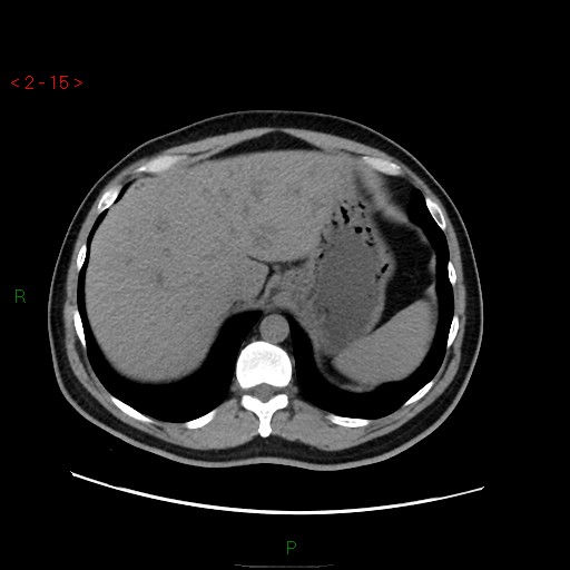 File:Ampullary carcinoma (Radiopaedia 56396-63056 Axial non-contrast 10).jpg