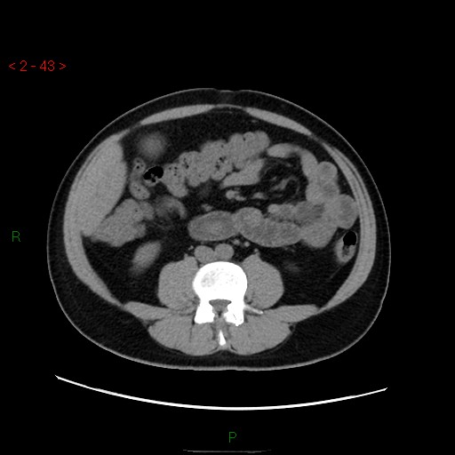 File:Ampullary carcinoma (Radiopaedia 56396-63056 Axial non-contrast 29).jpg