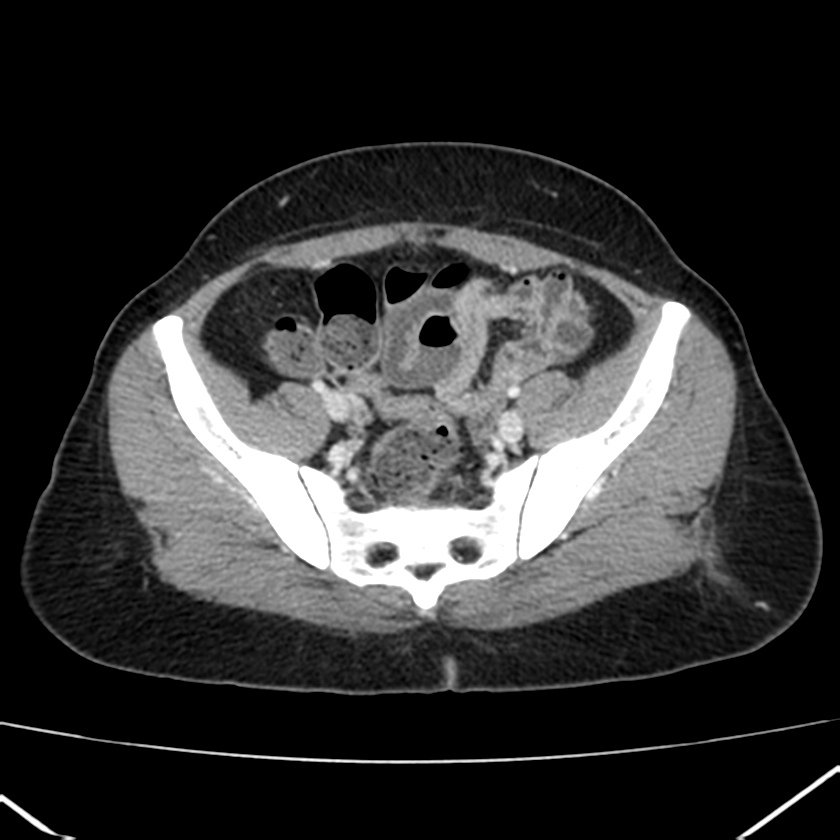 Ampullary tumor (Radiopaedia 22787-22816 C 55).jpg