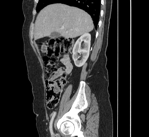 Ampullary tumor (Radiopaedia 60333-67998 C 14).jpg