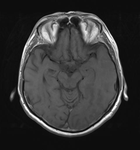 File:Amyloid angiopathy with inflammation (Radiopaedia 30360-31002 Axial T1 13).jpg