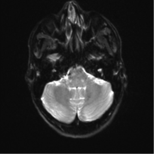 Anaplastic astrocytoma IDH mutant (Radiopaedia 50046-55341 Axial DWI 6).png