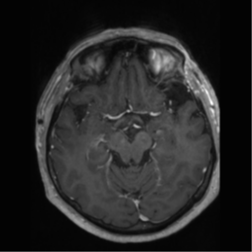 File:Anaplastic astrocytoma IDH wild-type (pseudoprogression) (Radiopaedia 42209-45277 Axial T1 C+ 48).png