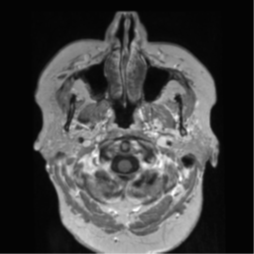 File:Anaplastic astrocytoma IDH wild-type (pseudoprogression) (Radiopaedia 42209-45278 Axial T1 C+ 19).png