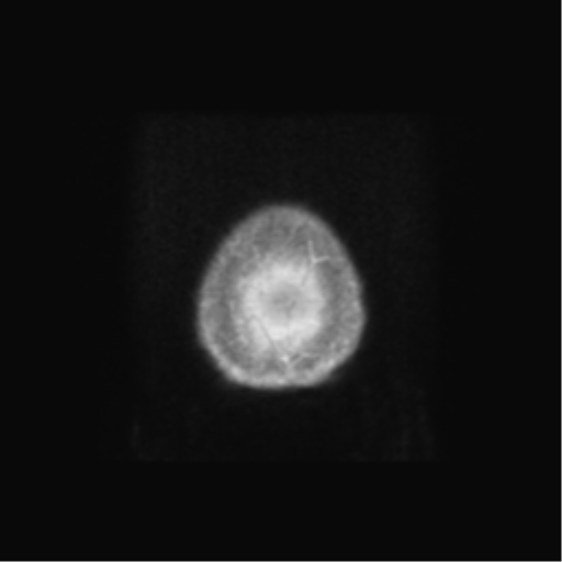 Anaplastic astrocytoma IDH wild-type (pseudoprogression) (Radiopaedia 42209-45279 Axial T1 C+ 146).png