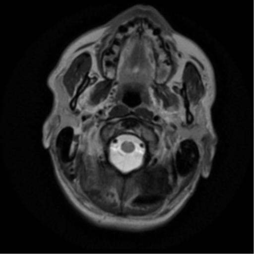 File:Anaplastic meningioma with recurrence (Radiopaedia 34452-35790 Axial T2 1).png
