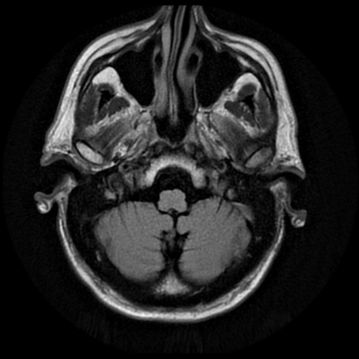 File:Anaplastic meningioma with recurrence (Radiopaedia 34452-35791 Axial FLAIR 3).png