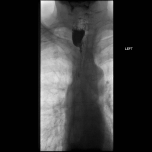 File:Anastomotic stricture post Ivor Lewis esophagectomy (Radiopaedia 47937-52715 B 2).png