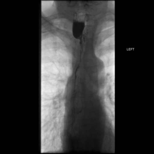 File:Anastomotic stricture post Ivor Lewis esophagectomy (Radiopaedia 47937-52715 B 22).png